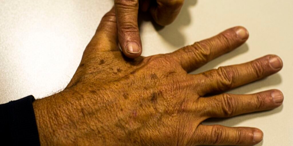 desinformacao-sobre-cancer-de-pele-afeta-diagnostico,-diz-instituicao