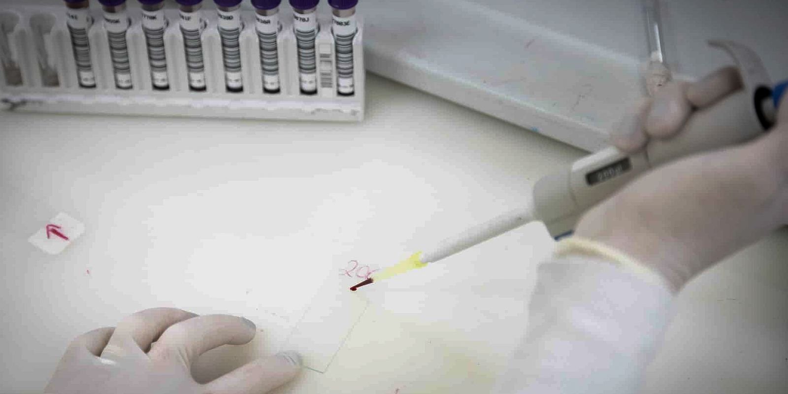 paciente-em-sp-com-suspeita-de-ebola-testa-positivo-para-meningite