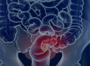 rastreamento-para-cancer-colorretal-pode-ser-implementado-no-sus